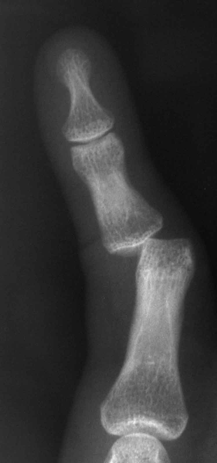 Dislocated finger joints
